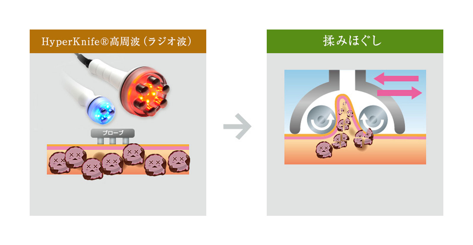 高周波 → 揉みほぐし